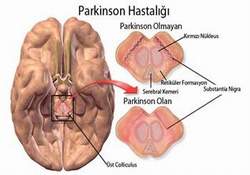 Parkinson hastalığında erken tedavi